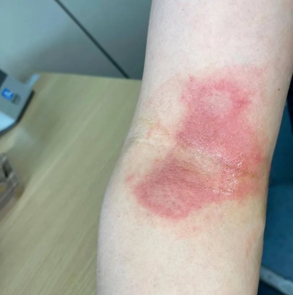 股票配资在线炒股配资 情侣夜游归来，男子手臂突然红肿糜烂，又疼又痒！医生：近期多人中招